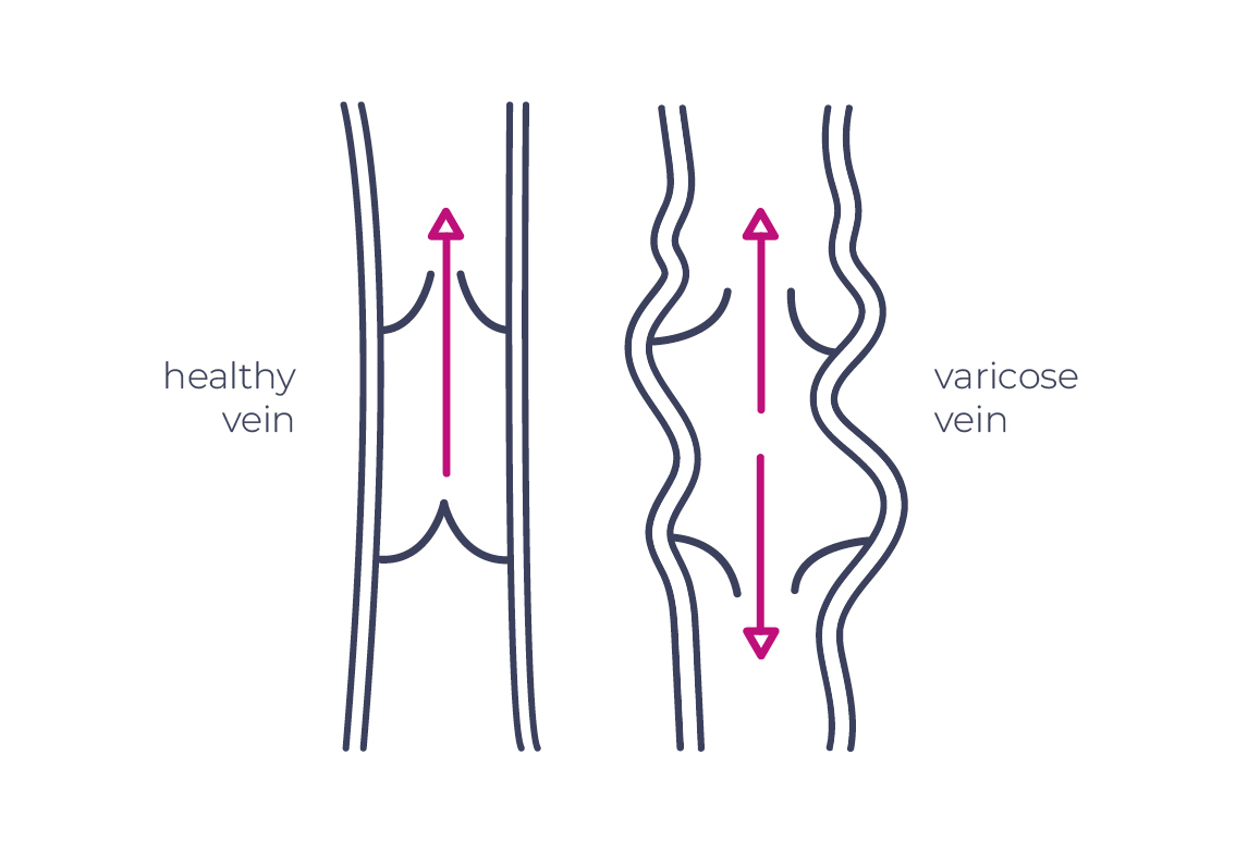How does ultrasound work in the treatment of varicose veins? Echotherapy