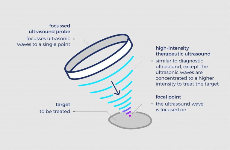 How Does Ultrasound Work In The Treatment Of Varicose Veins Echotherapy 7761