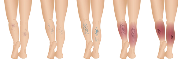 Top 10 reasons to get your legs checked out - You might have a